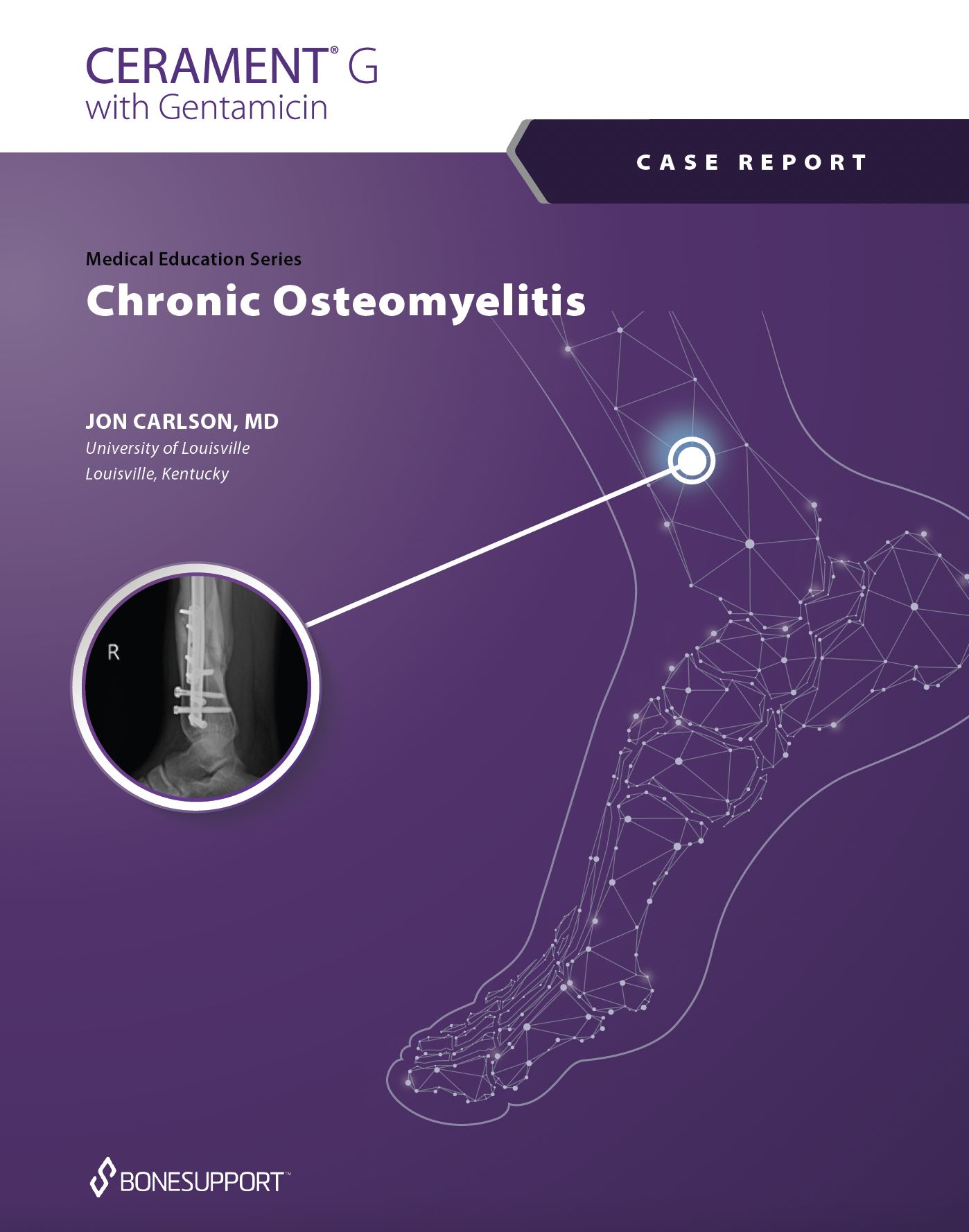 Chronic Osteomyelitis